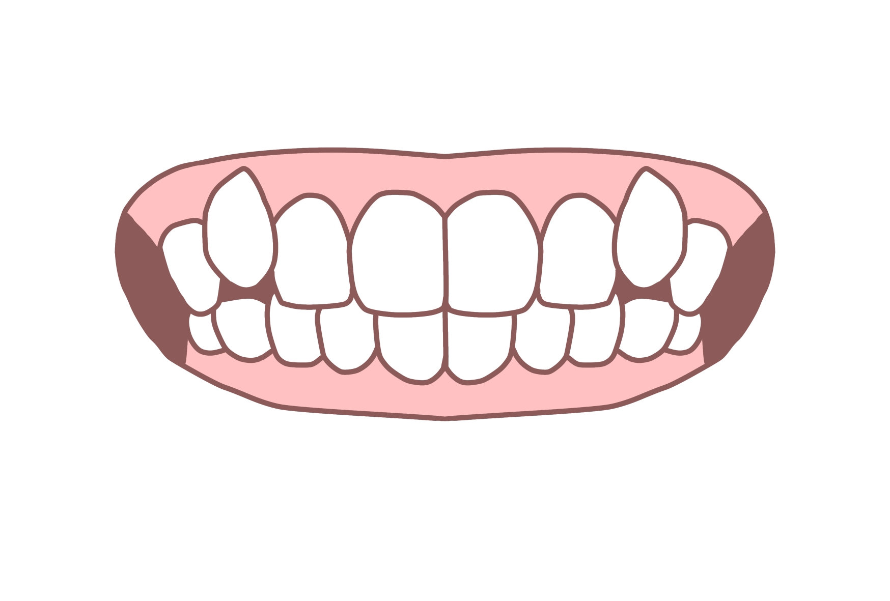 八重歯