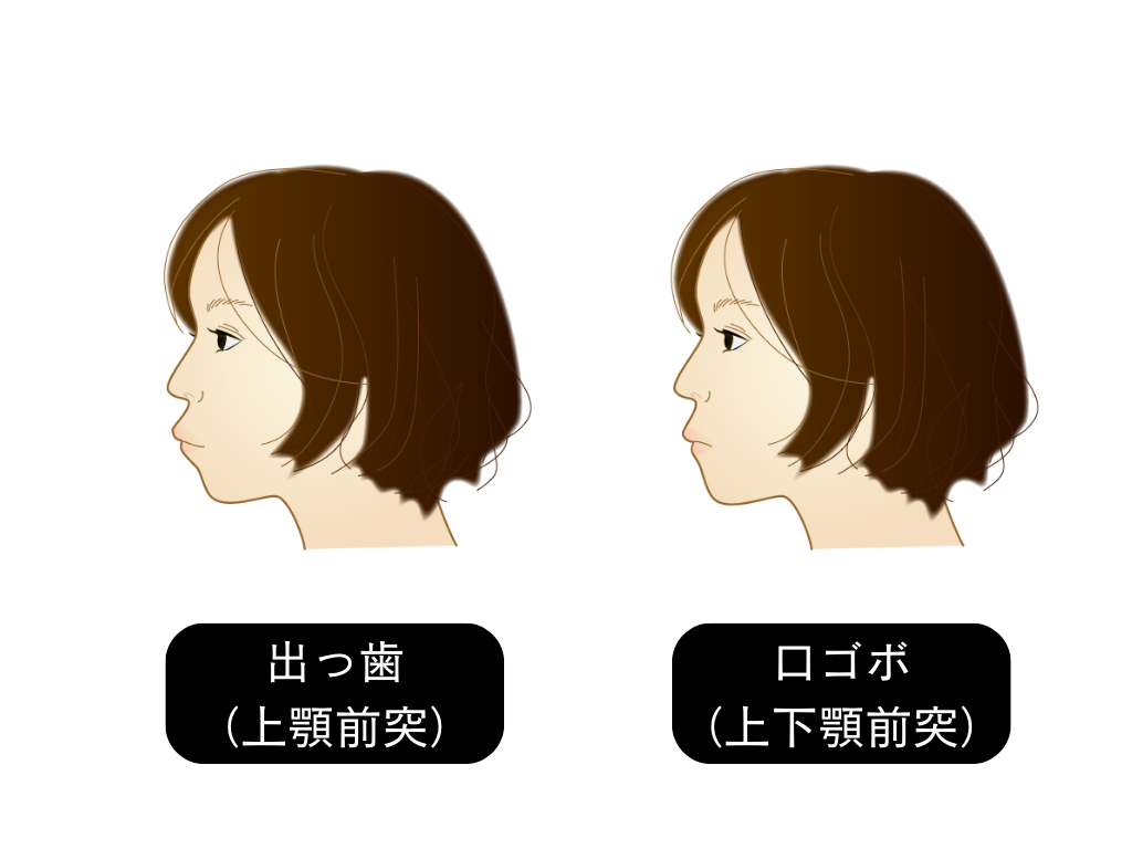 出っ歯・口ゴボ(口元の突出)の場合