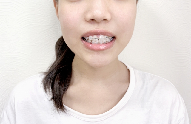 ◼️ワイヤー矯正
