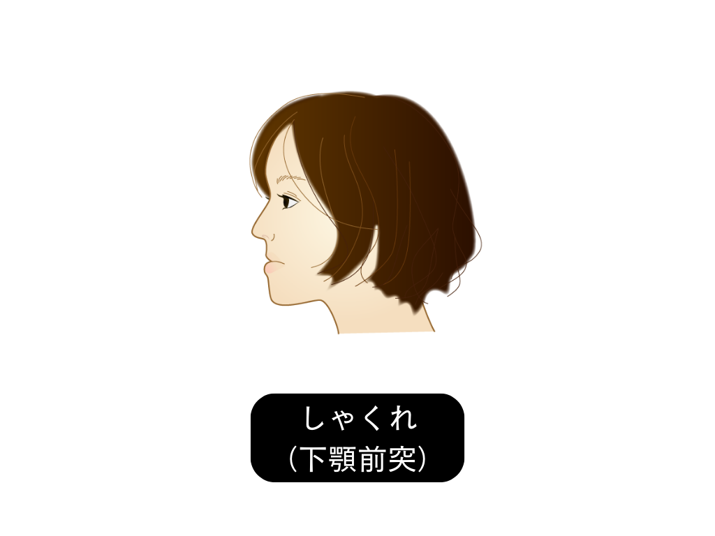 受け口・しゃくれの場合