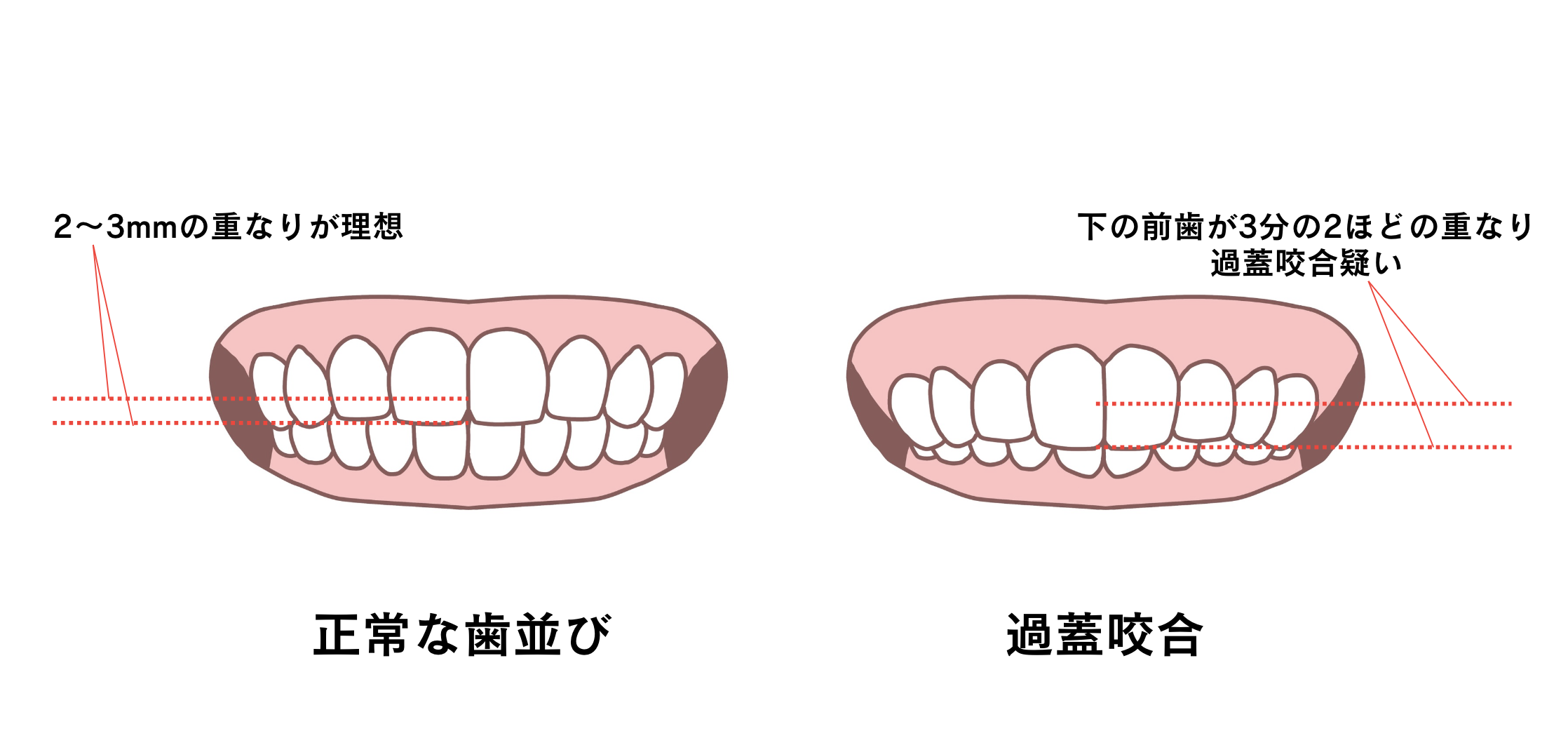 正常な噛み合わせとの違い