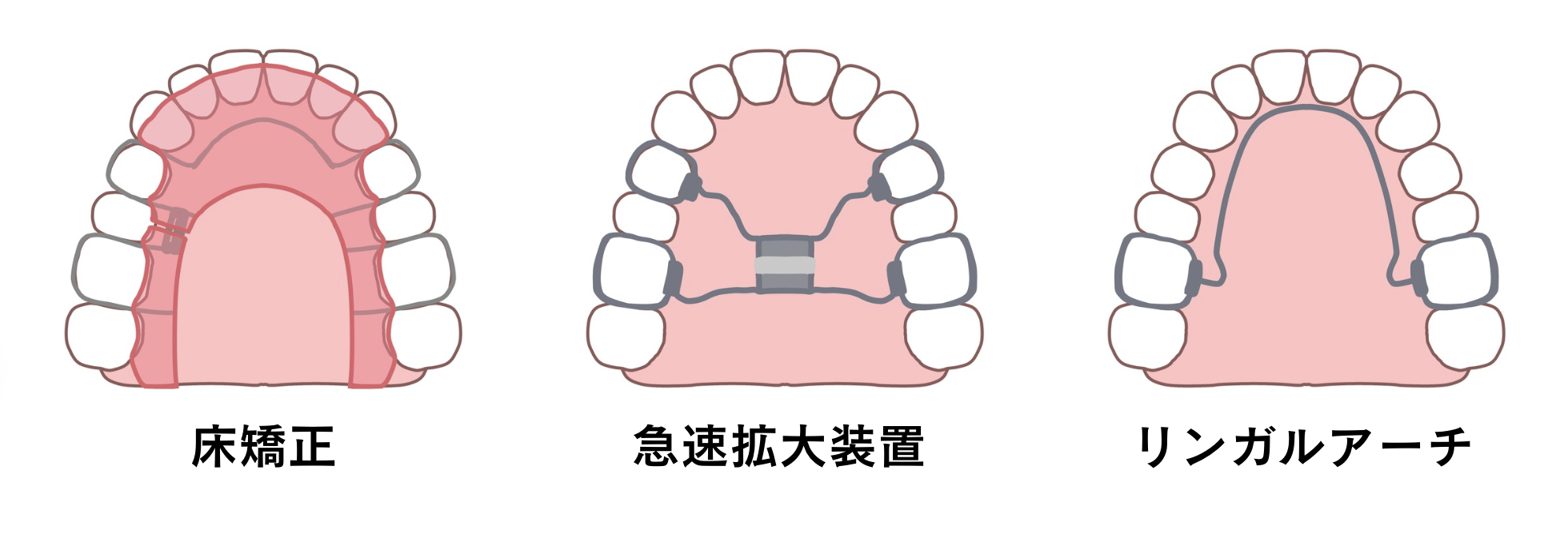よく使用される矯正装置