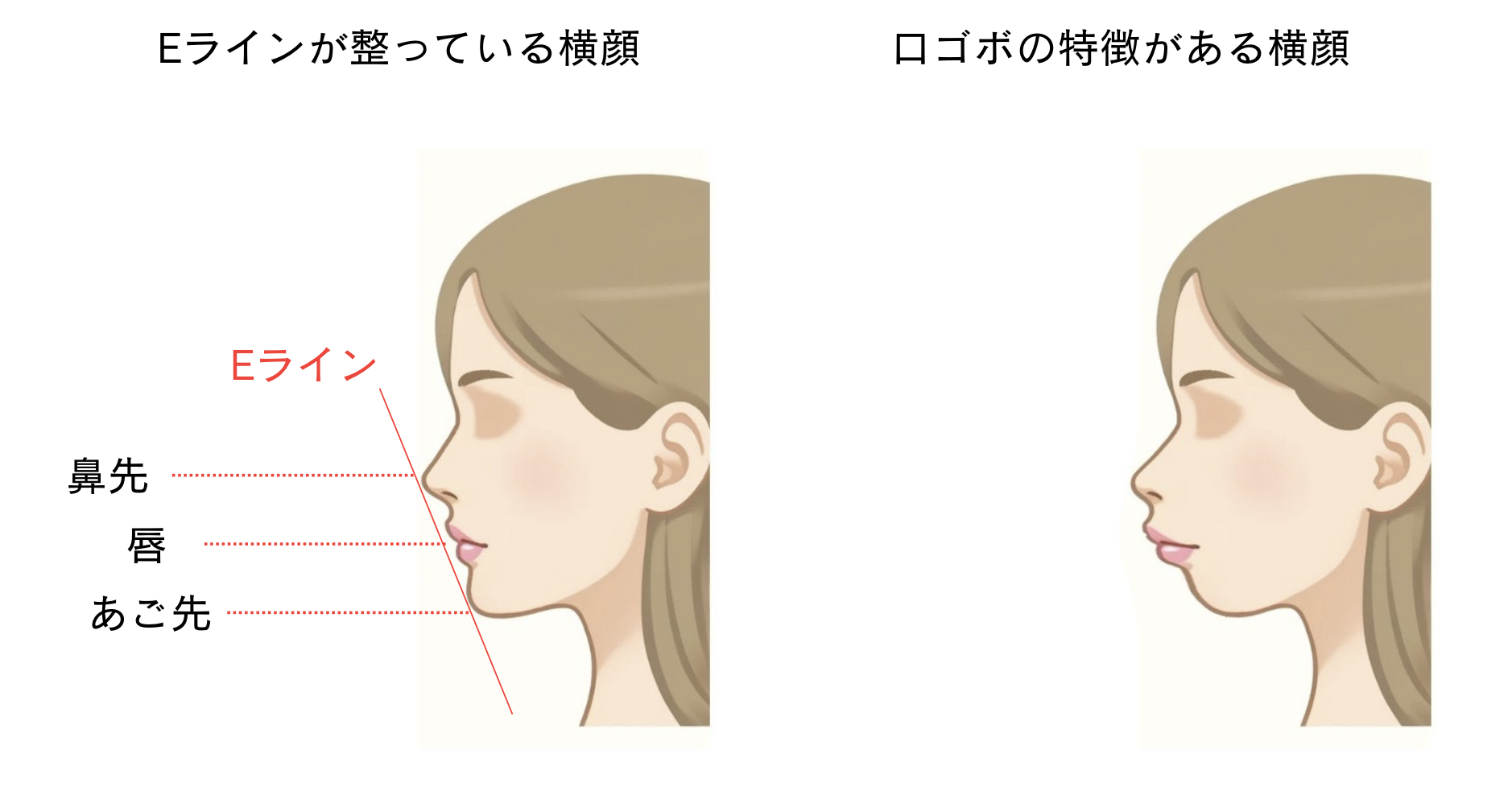 口ゴボってどんな状態?