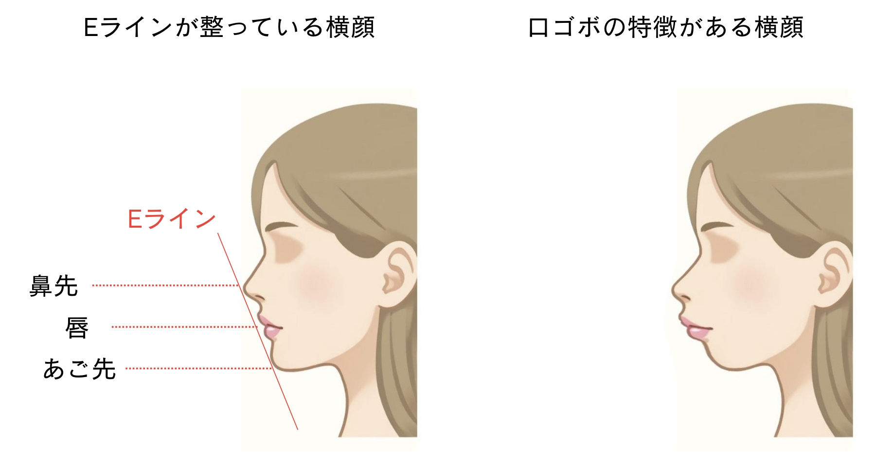 口ゴボってどんな状態?