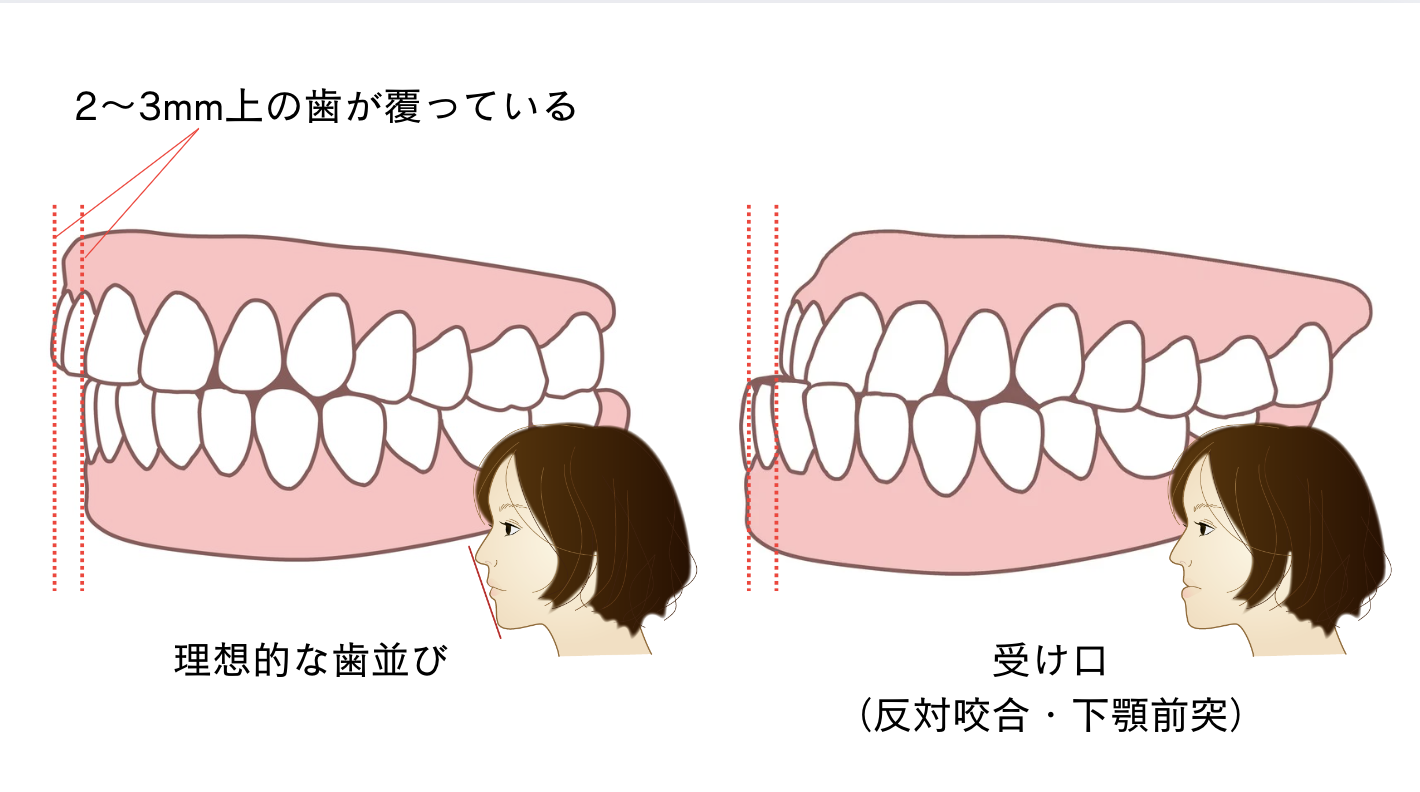 受け口（反対咬合・下顎前突）とは？