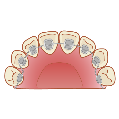裏側矯正(リンガル矯正)とは?