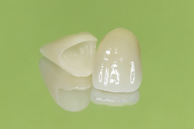 そもそもセラミックの歯ってどんな物？