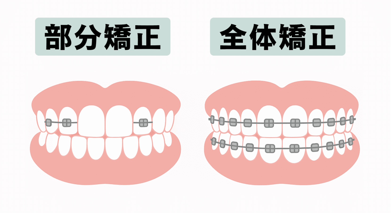 部分矯正とは?全体矯正との違いと特徴