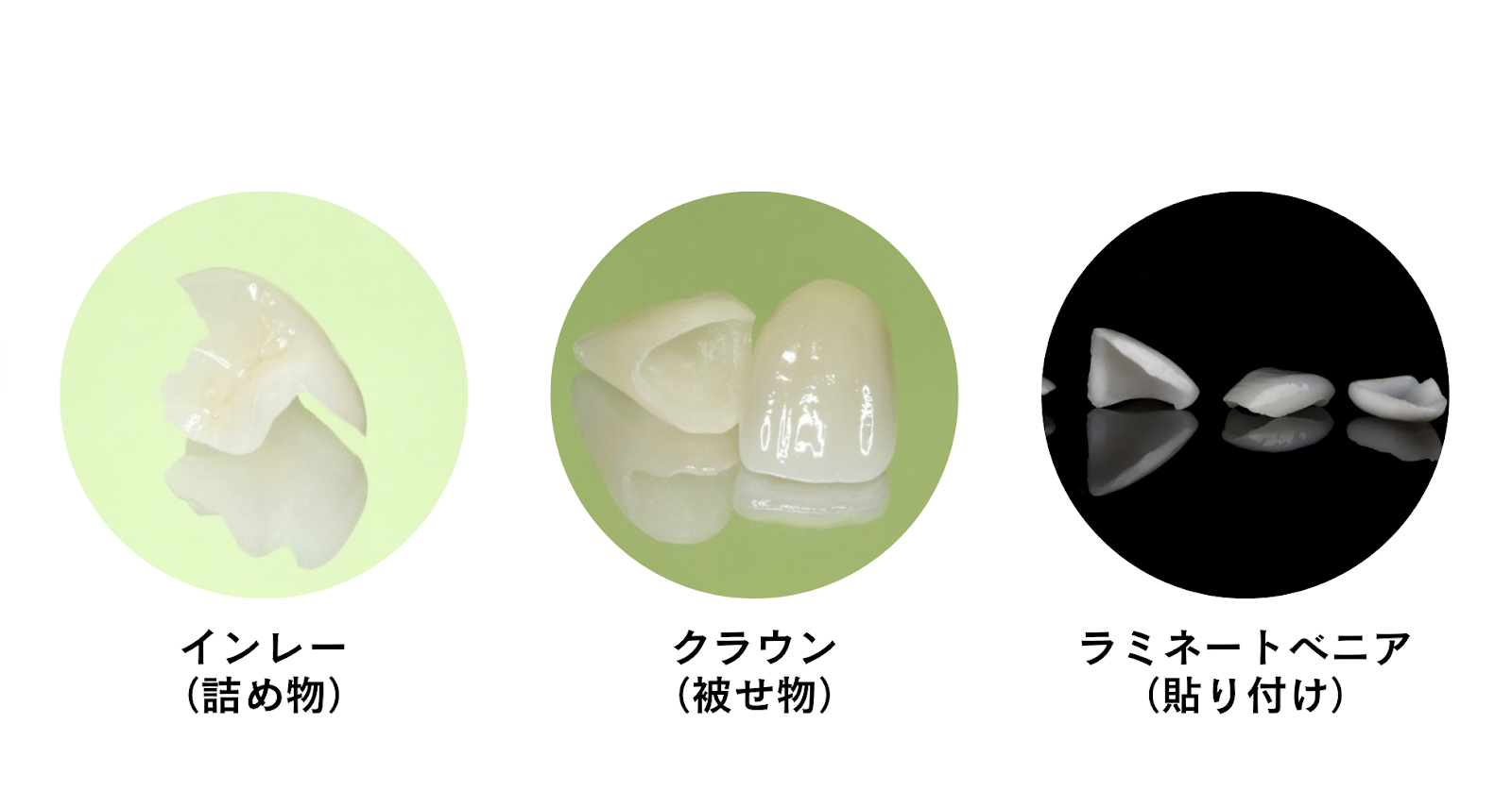 セラミック種類：インレー？クラウン？ラミネートベニア？それって何？