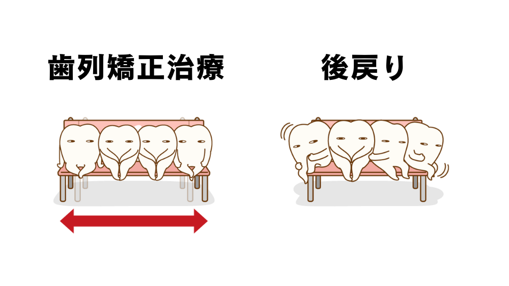 リテーナーが必要な理由