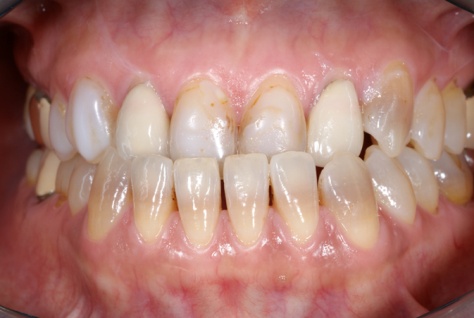 反対咬合before