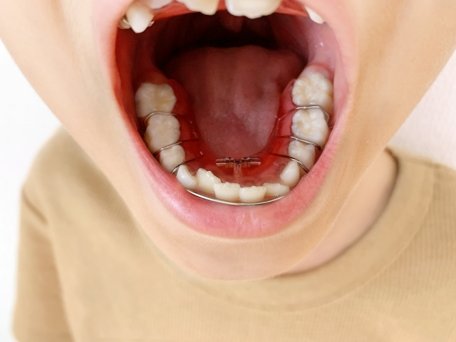 子どもの叢生は早めに矯正するとメリットが多い