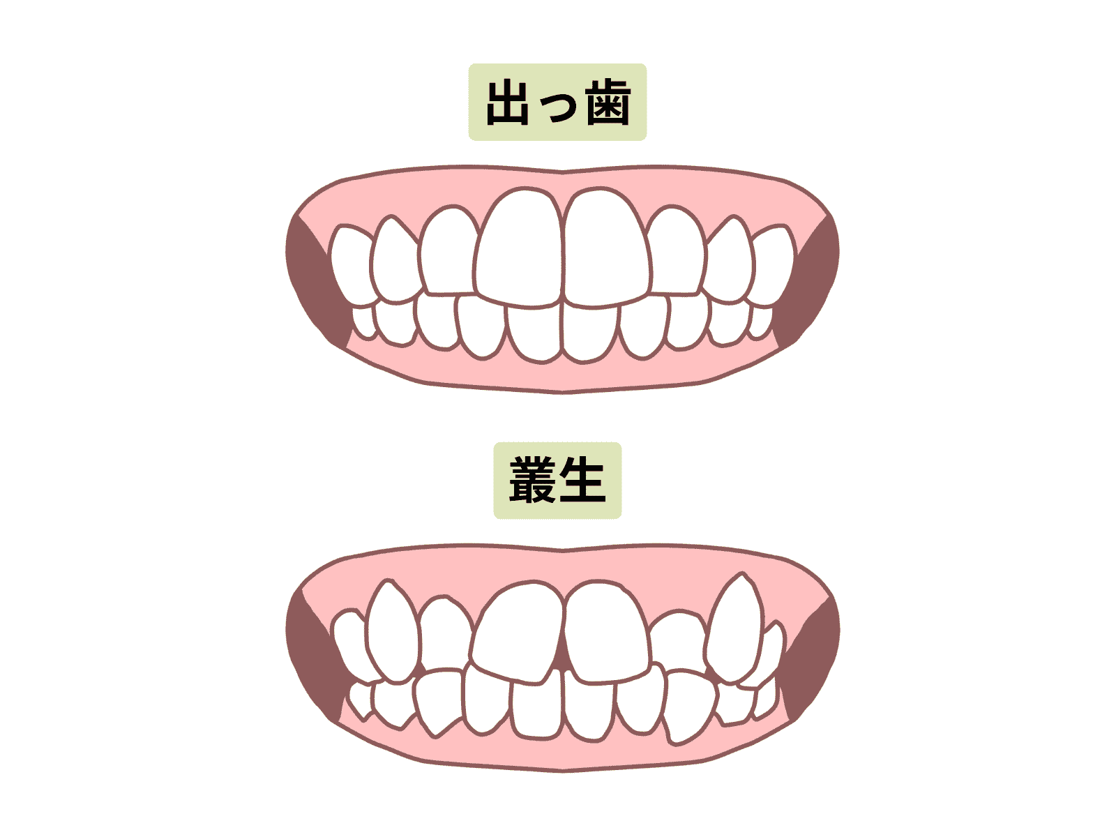歯並びが悪く前歯が目立つ(出っ歯・叢生)